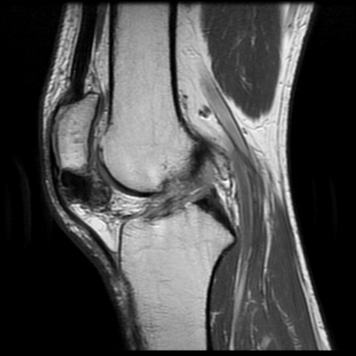 Figure 3 for case Parosteal osteoma ( RID4002 )